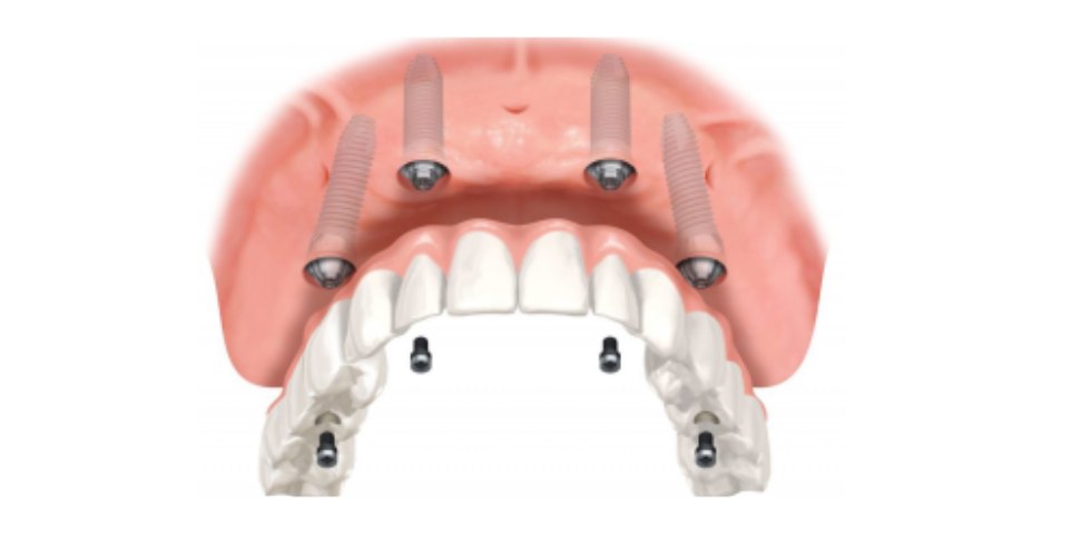 Denture Care